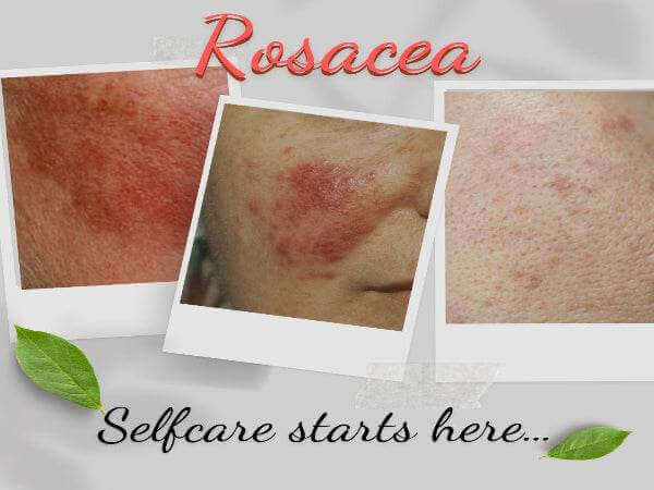 organic facial wash for rosacea-1